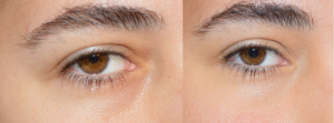 how to cover dark under eye circles before and after concealed eye